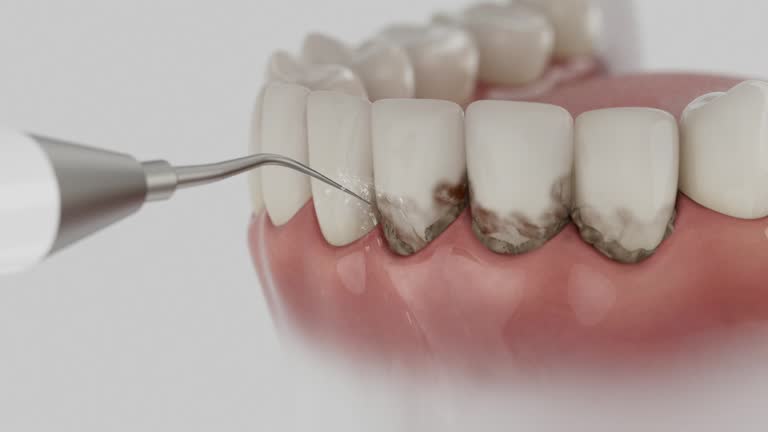 Reliable Tooth Extraction contractor in Azle, TX by Smile Center Dentistry